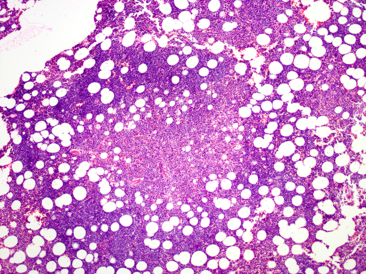Low-power view of the clot section with increased marrow cellularity and well-defined nodules of pale-appearing cells, which correspond to plasmacytoid dendritic cells.